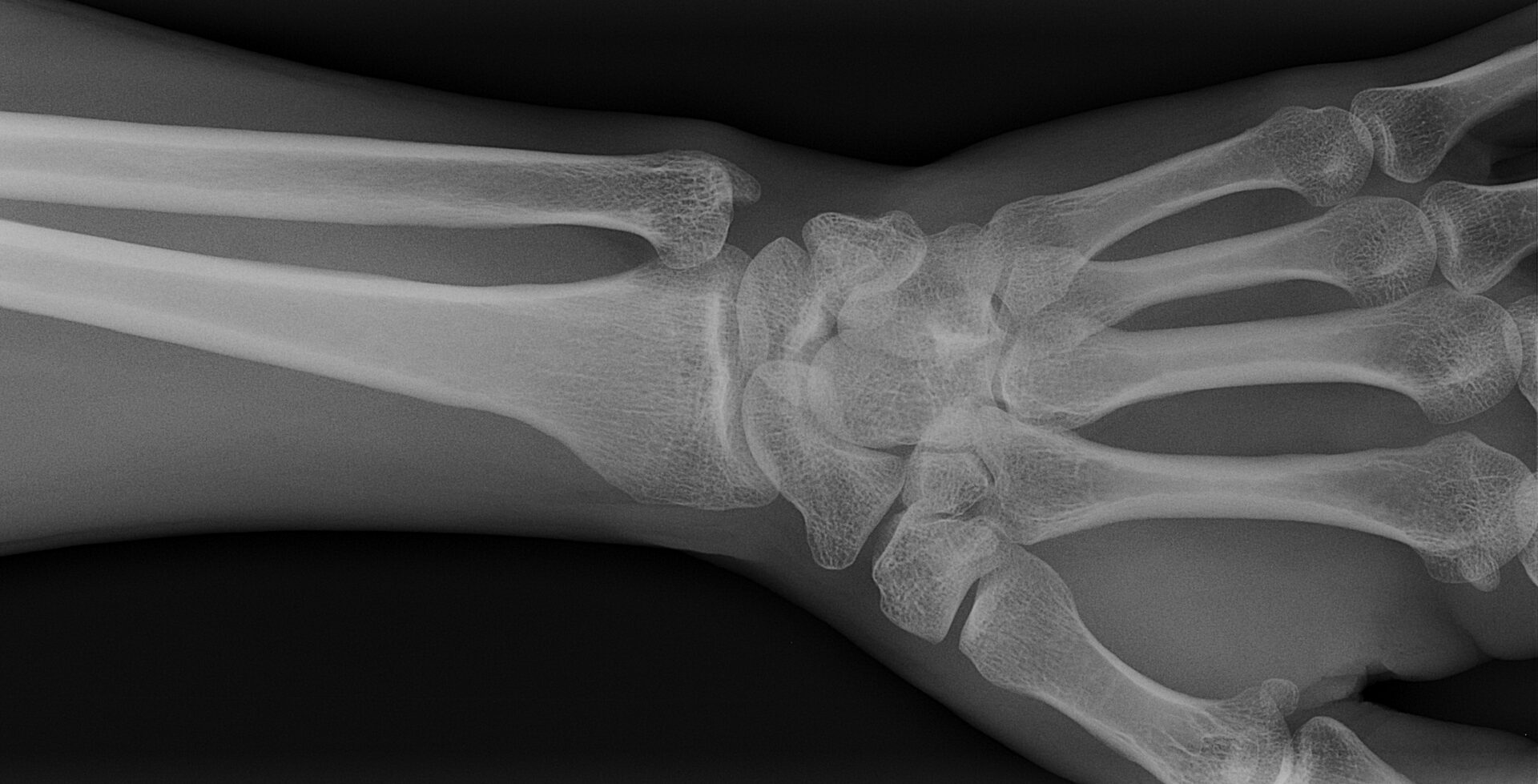 Radiographie du poignet